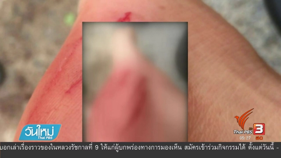 นทท. ถูกสัตว์ทะเลกัดเป็นแผล จ.ภูเก็ต