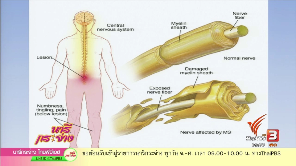 "ปลอกประสาทอักเสบ" โรคร้ายวัยทำงาน