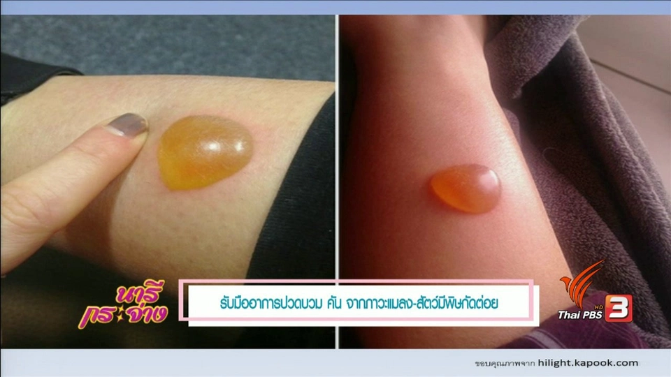 รับมืออาการจากแมลงสัตว์กัดต่อย