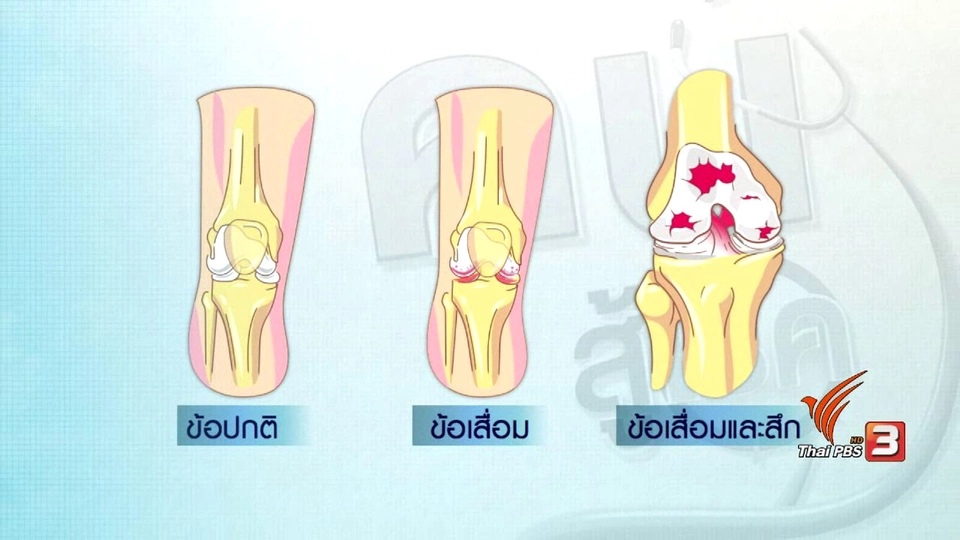 ปรับก่อนป่วย : กายภาพบำบัดแก้อาการข้อเข่าเสื่อม