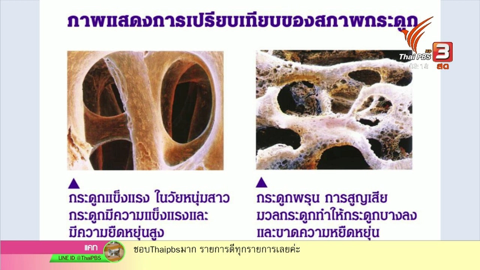 นารีสนทนา : กินให้เป็น รู้ให้ทัน ป้องกันกระดูกพรุน