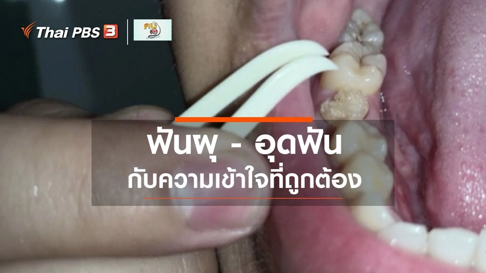 รู้สู้โรค : ความเข้าใจที่ถูกต้องเรื่องฟันผุ และการอุดฟัน