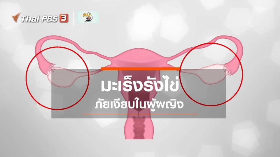 ​รู้สู้โรค : มะเร็งรังไข่ ภัยเงียบในผู้ผญิง