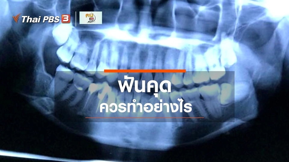 ​รู้สู้โรค : "ฟันคุด" ควรทำอย่างไร