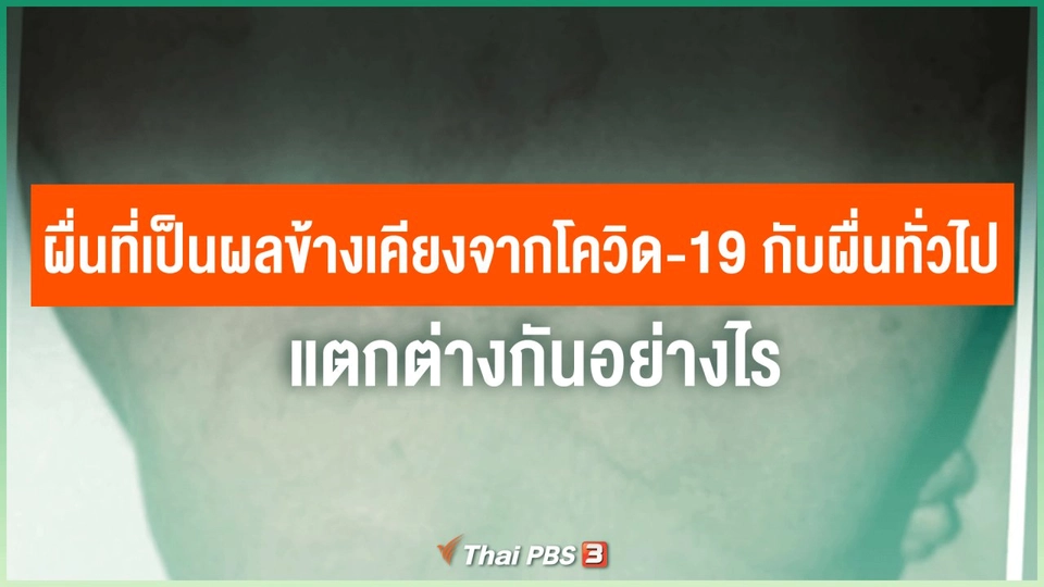 ​ผื่นที่เป็นผลข้างเคียงจากโควิด-19 กับผื่นทั่วไป แตกต่างกันอย่างไร