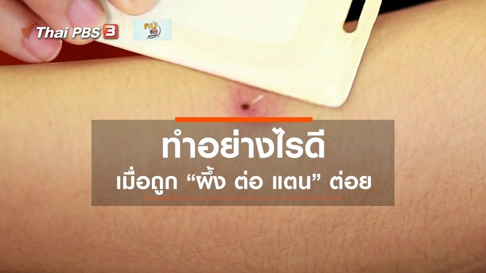 รู้สู้โรค : ปฐมพยาบาลผู้ถูกสัตว์มีพิษกัดต่อย