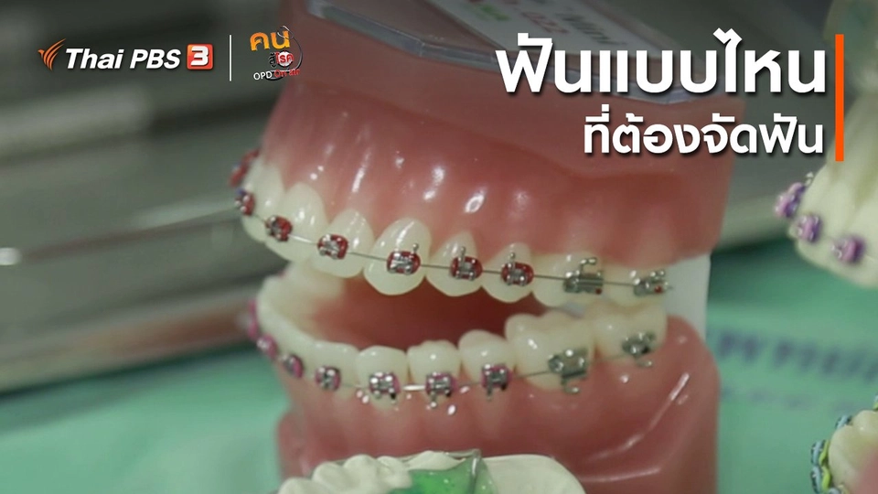 รู้สู้โรค : ฟันแบบไหน ที่ต้องจัดฟัน
