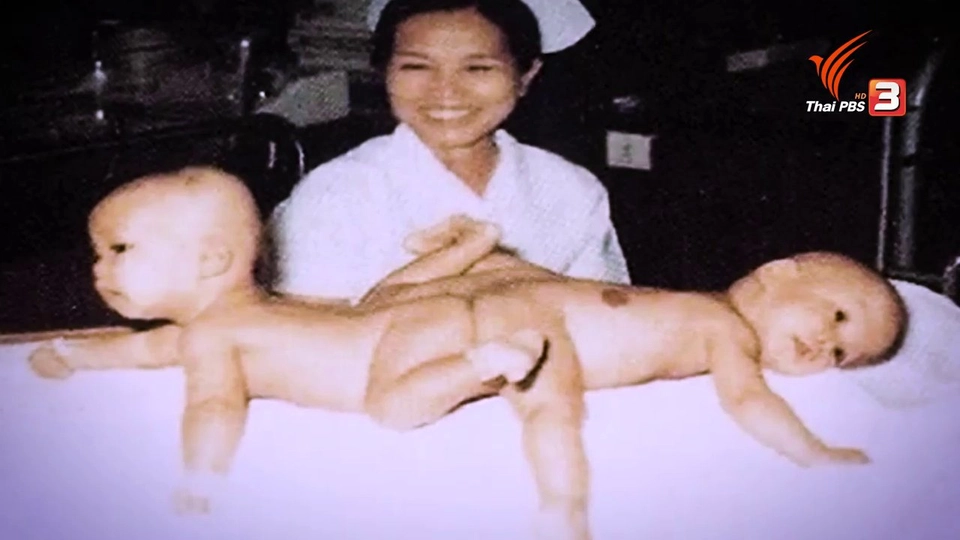 ​แฝดสยาม ปู-เป้ กับการผ่าตัดครั้งสำคัญ