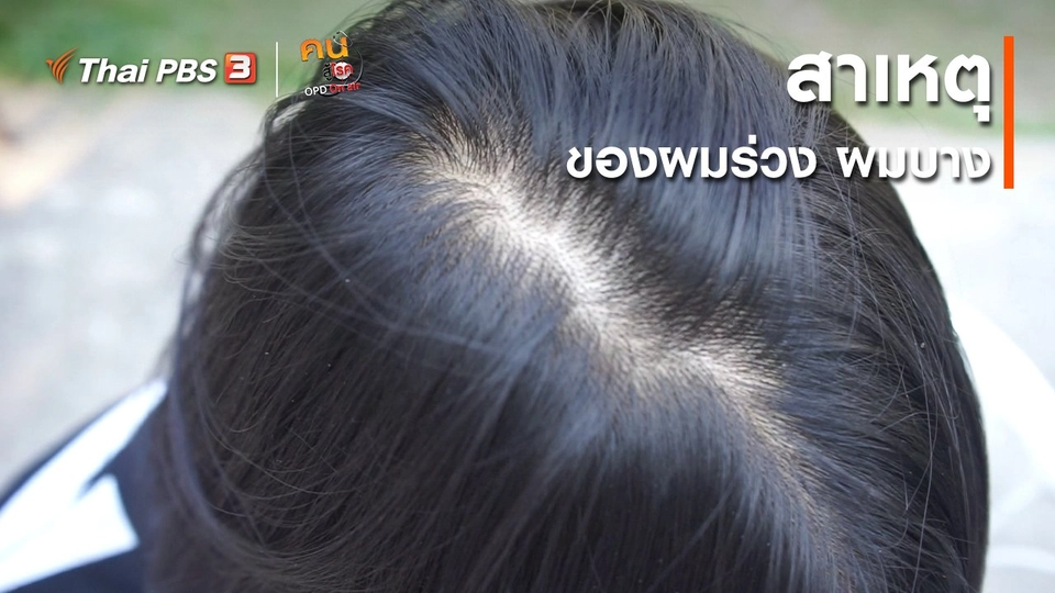 รู้สู้โรค : สาเหตุของผมร่วง ผมบาง