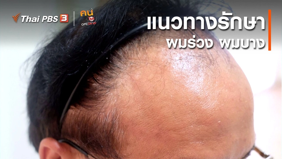 รู้สู้โรค : แนวทางรักษาผมร่วง ผมบาง