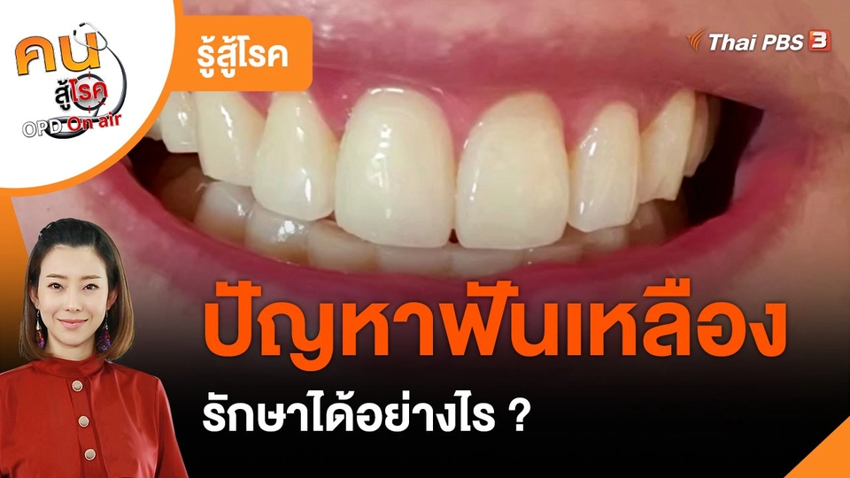 รู้สู้โรค : ปัญหาฟันเหลือง