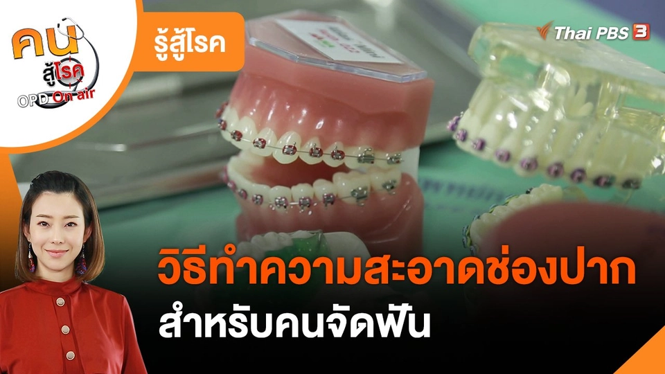 รู้สู้โรค : วิธีทำความสะอาดช่องปากสำหรับคนจัดฟัน