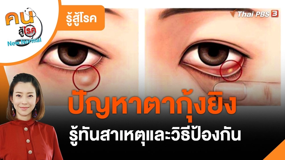 ​รู้สู้โรค : ปัญหาตากุ้งยิง