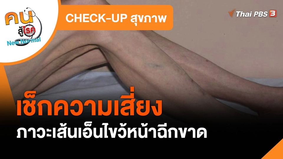 CHECK-UP สุขภาพ : เช็กภาวะเส้นเอ็นไขว้หน้าฉีกขาด