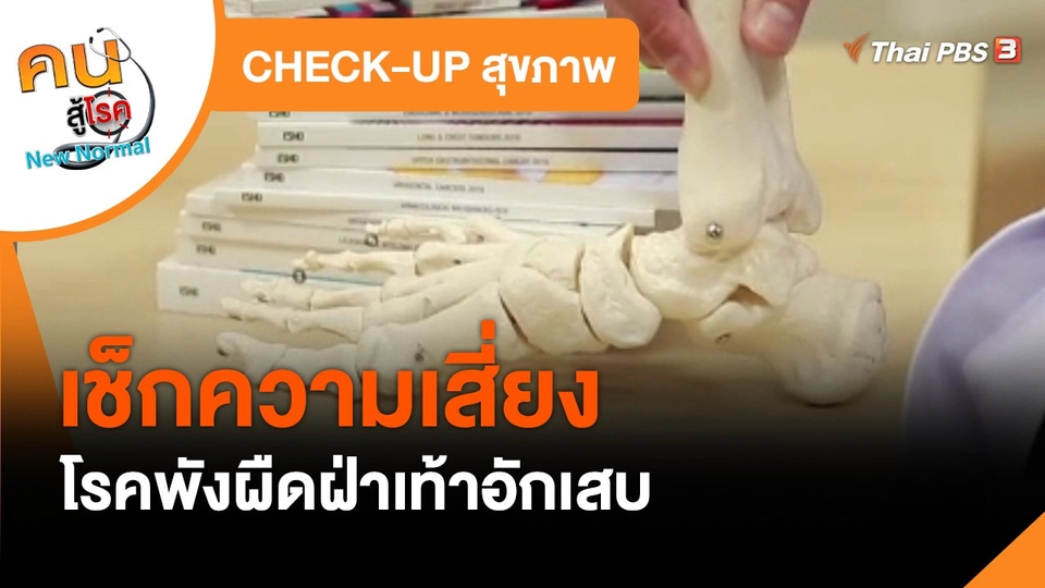 CHECK-UP สุขภาพ : เช็กความเสี่ยงเป็นโรคพังผืดฝ่าเท้าอักเสบ
