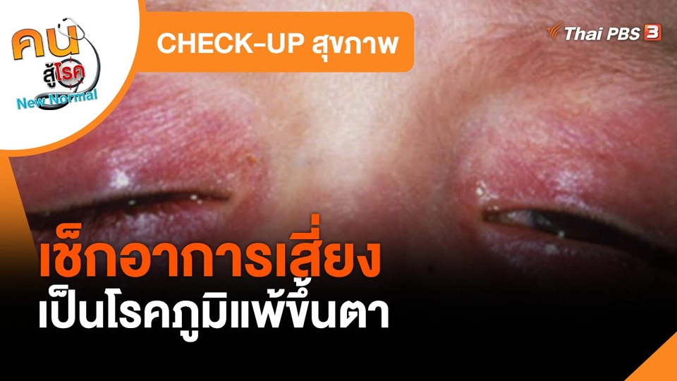 CHECK-UP สุขภาพ : เช็กอาการเสี่ยงเป็นโรคภูมิแพ้ขึ้นตา