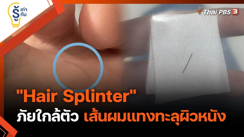 รู้เท่ารู้ทัน : "Hair Splinter" ภัยใกล้ตัว เส้นผมแทงทะลุผิวหนัง