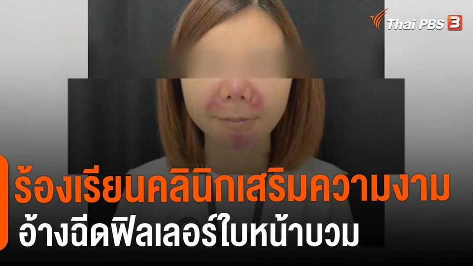สถานีร้องเรียน : ร้องคลินิกเสริมความงามอ้างฉีดฟิลเลอร์ใบหน้าบวม