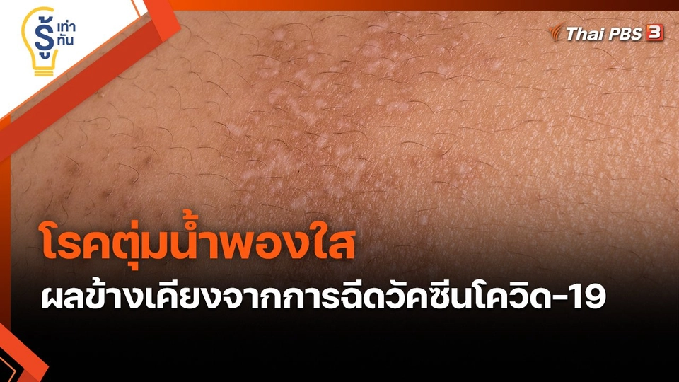 ​รู้เท่ารู้ทัน : โรคตุ่มน้ำพองใส ผลข้างเคียงจากการฉีดวัคซีนโควิด-19