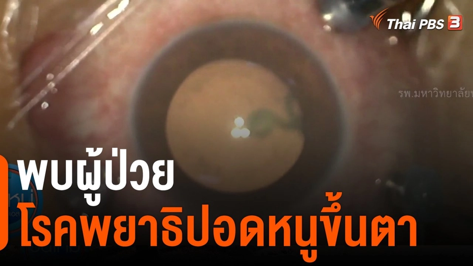 พบผู้ป่วยโรคพยาธิปอดหนูขึ้นตา จ.พิษณุโลก