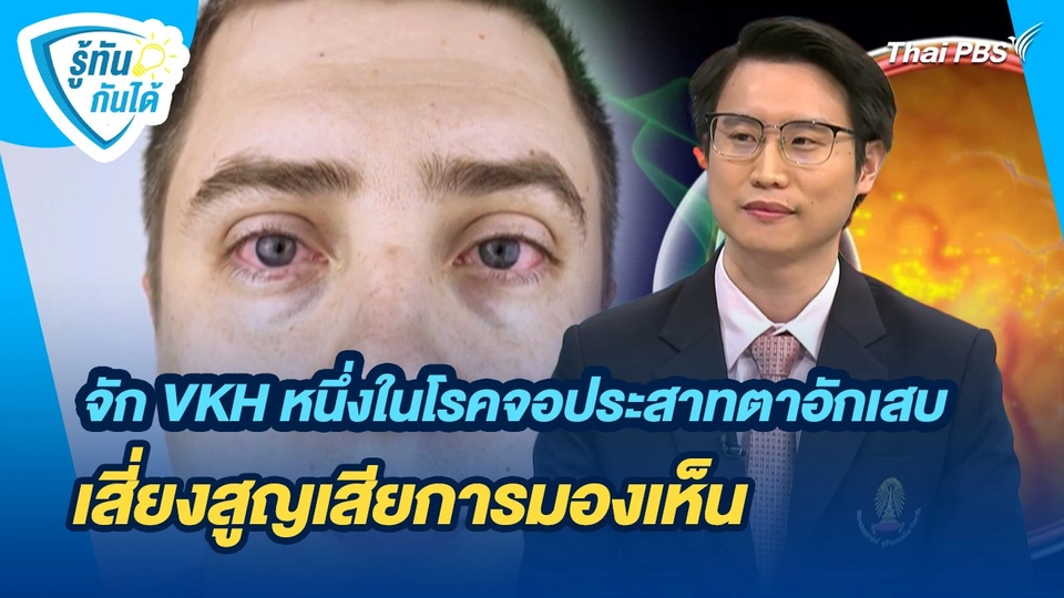 รู้ทันกันได้ : รู้จัก VKH หนึ่งในโรคจอประสาทตาอักเสบ เสี่ยงสูญเสียการมองเห็น