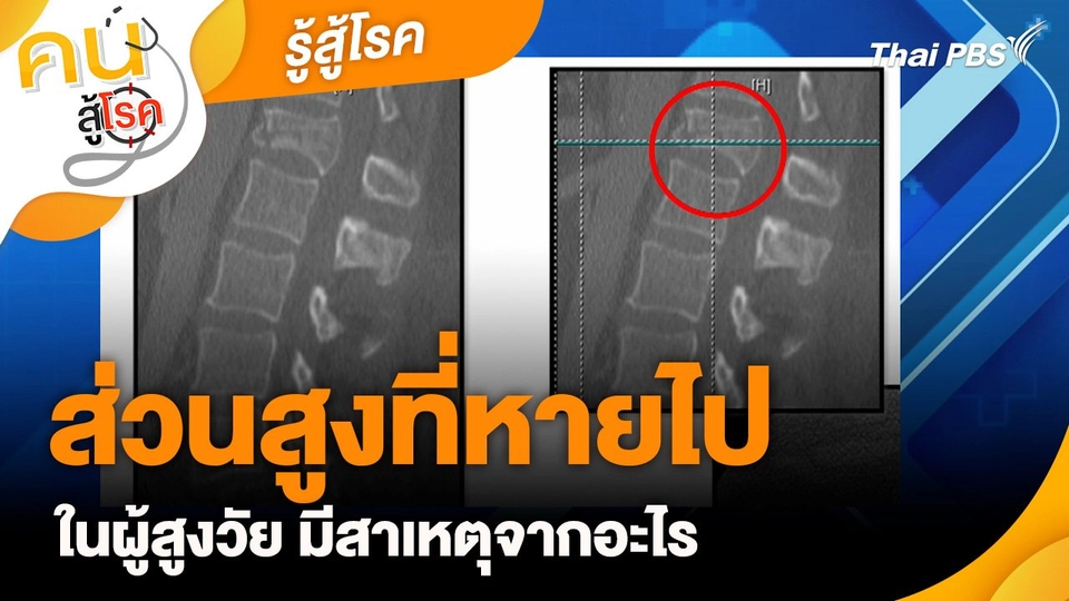 รู้สู้โรค : ส่วนสูงที่หายไปในผู้สูงวัย มีสาเหตุจากอะไร