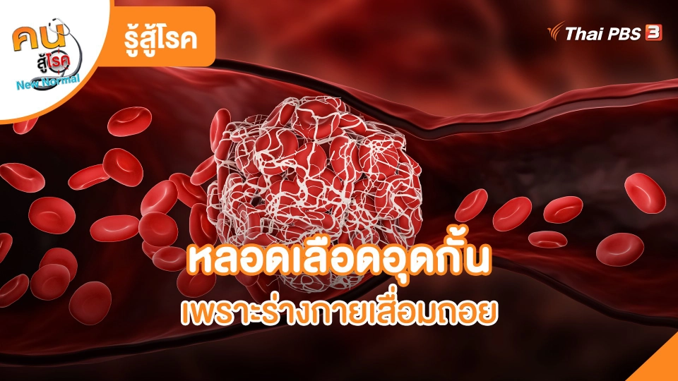 รู้สู้โรค : หลอดเลือดอุดกั้นเพราะร่างกายเสื่อมถอย