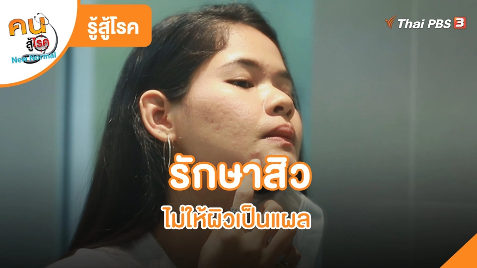 รักษาสิว ไม่ให้ผิวเป็นแผล