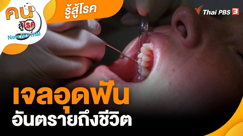 ​รู้สู้โรค : เจลอุดฟันอันตรายถึงชีวิต