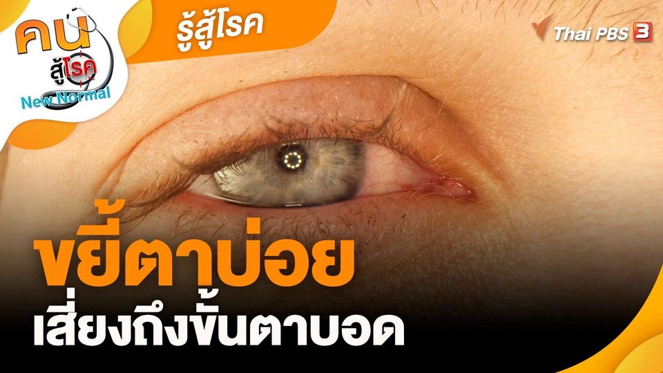 ​รู้สู้โรค : ขยี้ตาบ่อยเสี่ยงถึงขั้นตาบอด