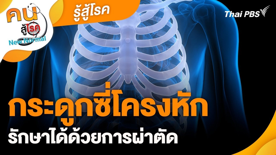 รู้สู้โรค : กระดูกซี่โครงหักรักษาได้ด้วยการผ่าตัด