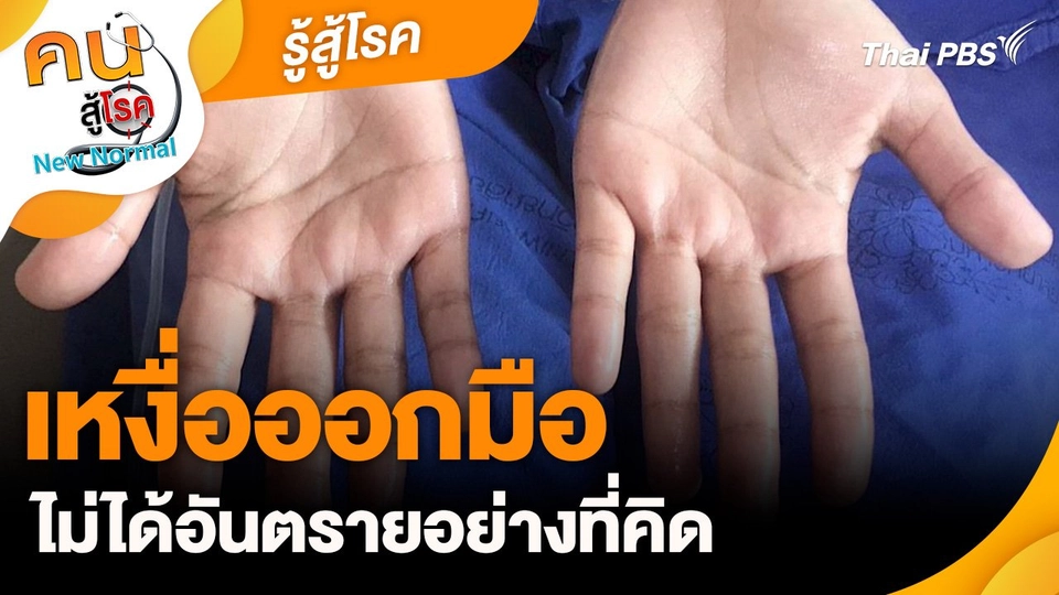 รู้สู้โรค : เหงื่อออกมือ