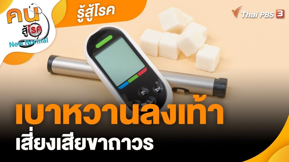 ​รู้สู้โรค : เบาหวานลงเท้าเสี่ยงเสียขาถาวร