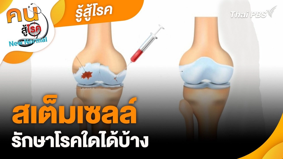 รู้สู้โรค : สเต็มเซลล์ รักษาโรคใดได้บ้าง