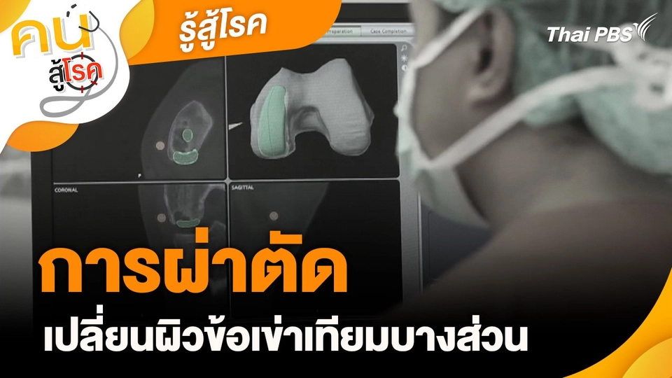 รู้สู้โรค : การผ่าตัดเปลี่ยนผิวข้อเข่าเทียมบางส่วน