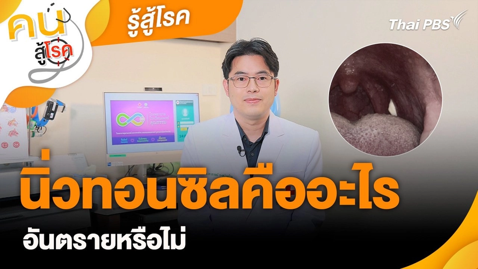 รู้สู้โรค : นิ่วทอนซิลคืออะไร อันตรายหรือไม่