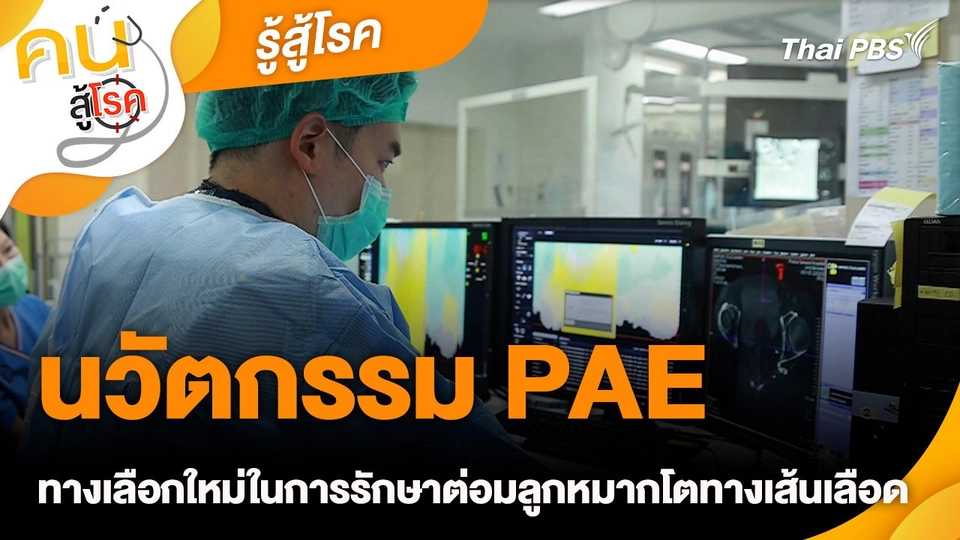 รู้สู้โรค : นวัตกรรม PAE ทางเลือกใหม่ในการรักษาต่อมลูกหมากโตทางเส้นเลือด