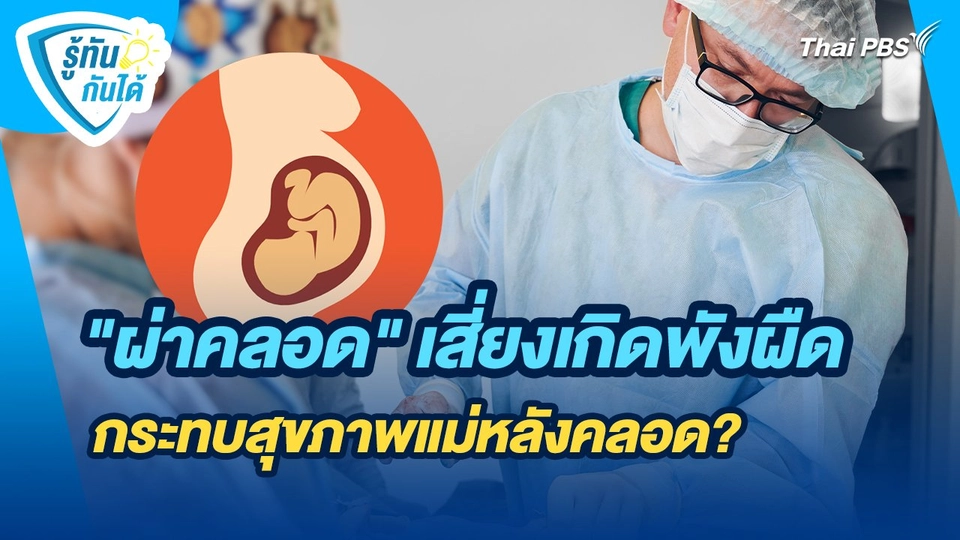รู้ทันกันได้ : "ผ่าคลอด" เสี่ยงเกิดพังผืด กระทบสุขภาพแม่หลังคลอด?