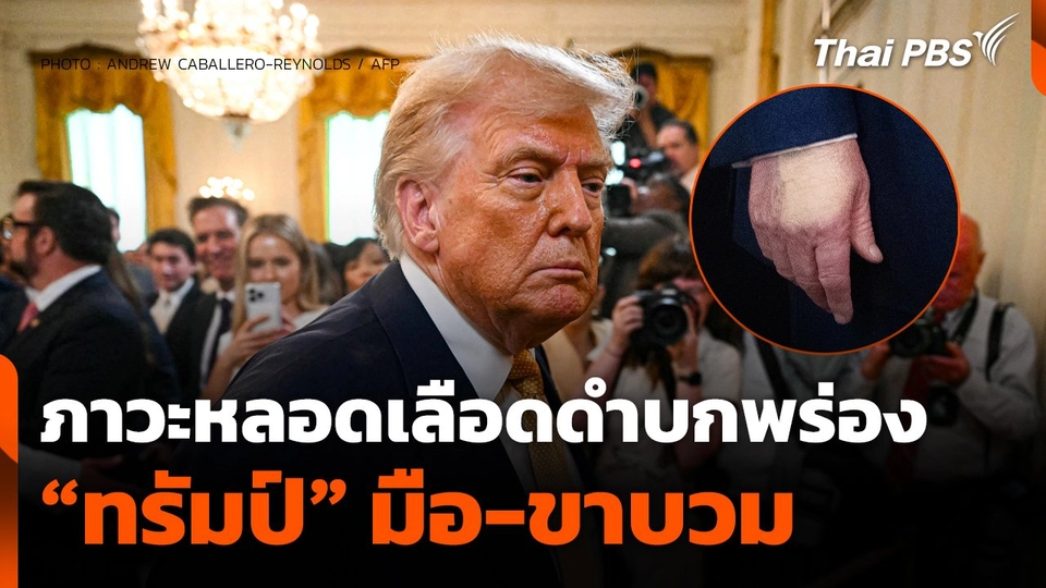 "ทรัมป์" มือ-ขาบวม จากภาวะหลอดเลือดดำบกพร่อง