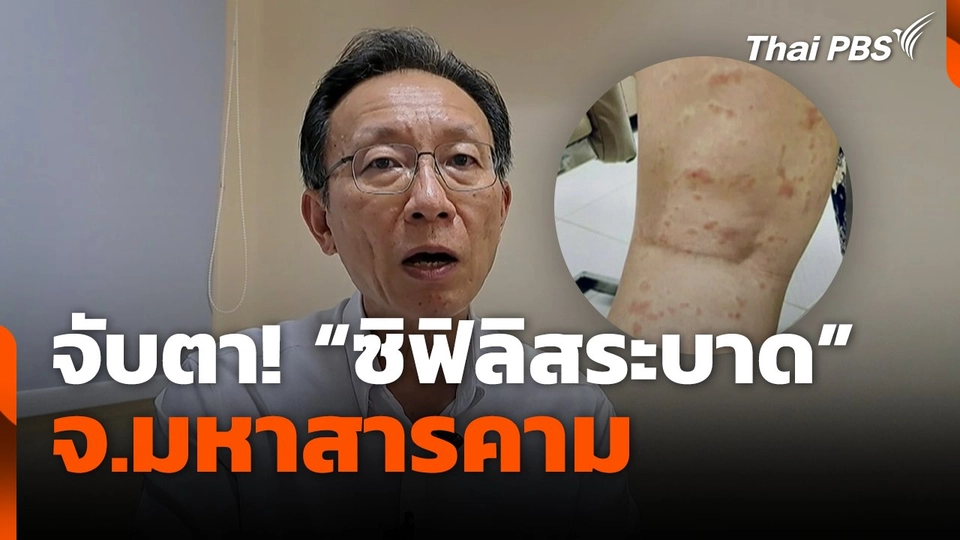 จับตา! "ซิฟิลิสระบาด" จ.มหาสารคาม
