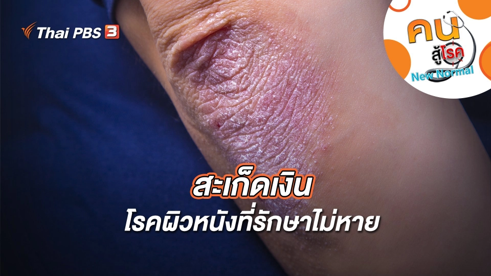 สะเก็ดเงินโรคผิวหนังที่รักษาไม่หาย