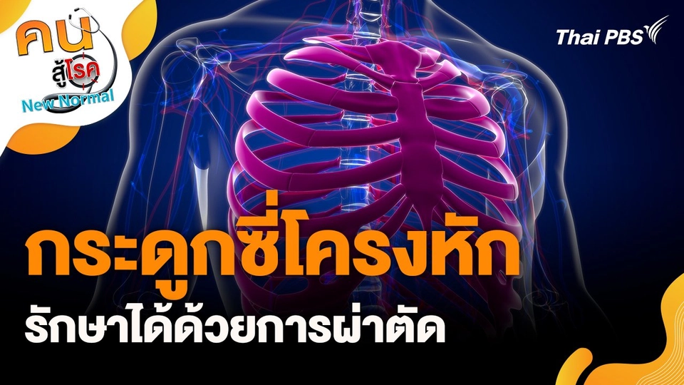 กระดูกซี่โครงหักรักษาได้ด้วยการผ่าตัด