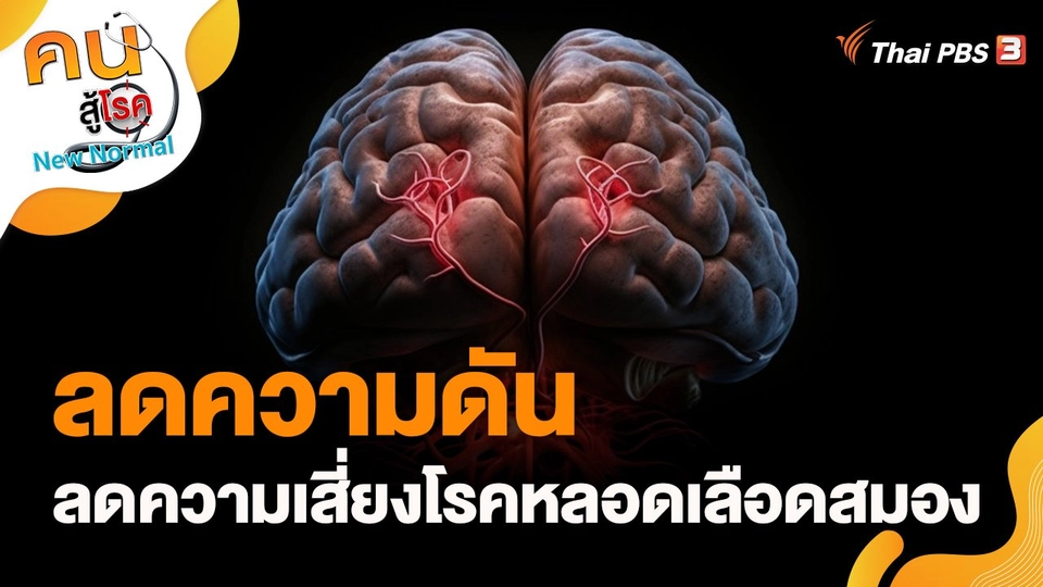 ลดความดันลดความเสี่ยงโรคหลอดเลือดสมอง