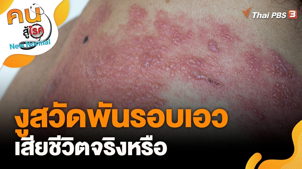 งูสวัดพันรอบเอวแล้วเสียชีวิตจริงหรือ