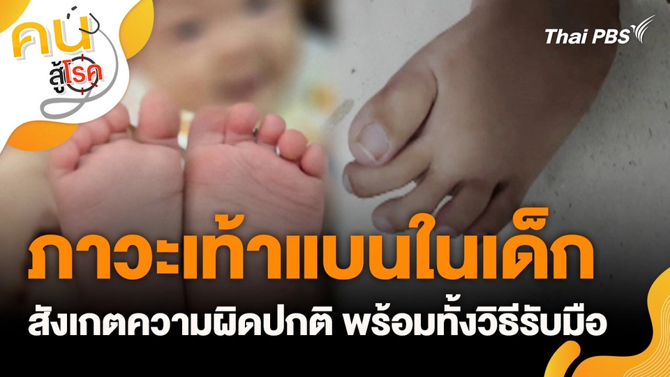 ภาวะเท้าแบนในเด็ก