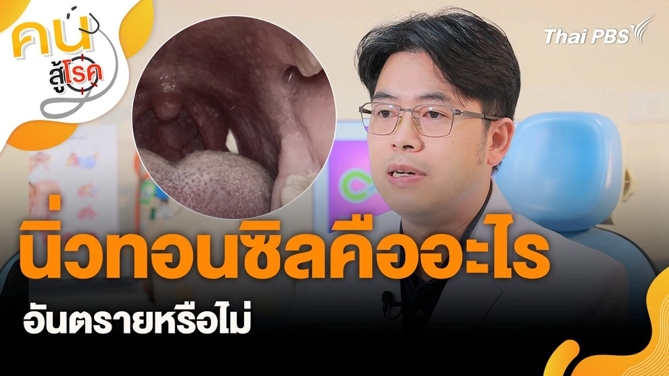 นิ่วทอนซิลคืออะไร อันตรายหรือไม่