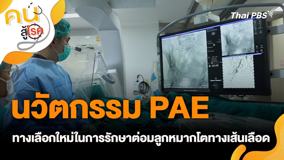 นวัตกรรม PAE ทางเลือกใหม่ในการรักษาต่อมลูกหมากโตทางเส้นเลือด