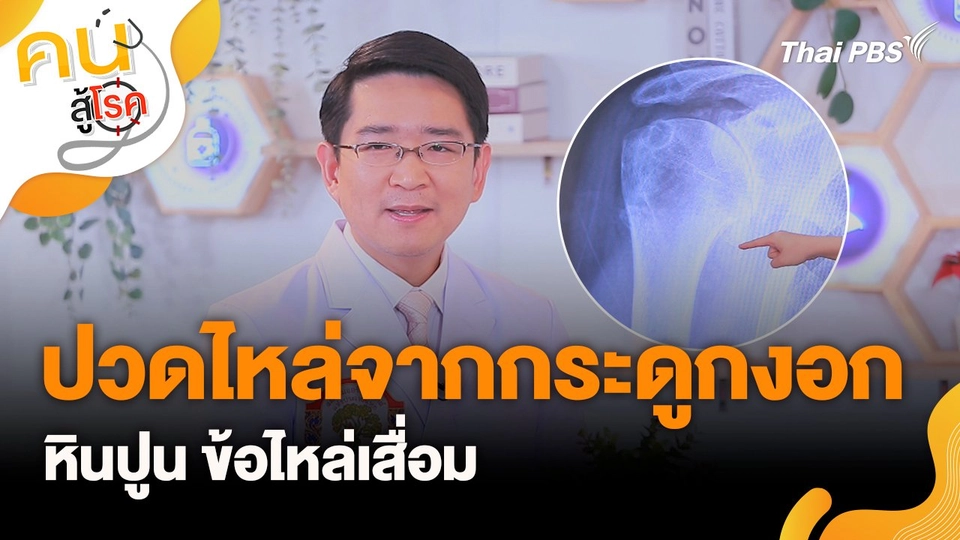ปวดไหล่จากกระดูกงอก หินปูน ข้อไหล่เสื่อม