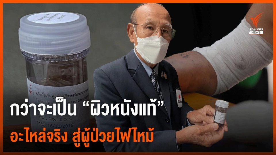 กว่าจะเป็น "ผิวหนังแท้" อะไหล่จริง สู่ผู้ป่วยไฟไหม้