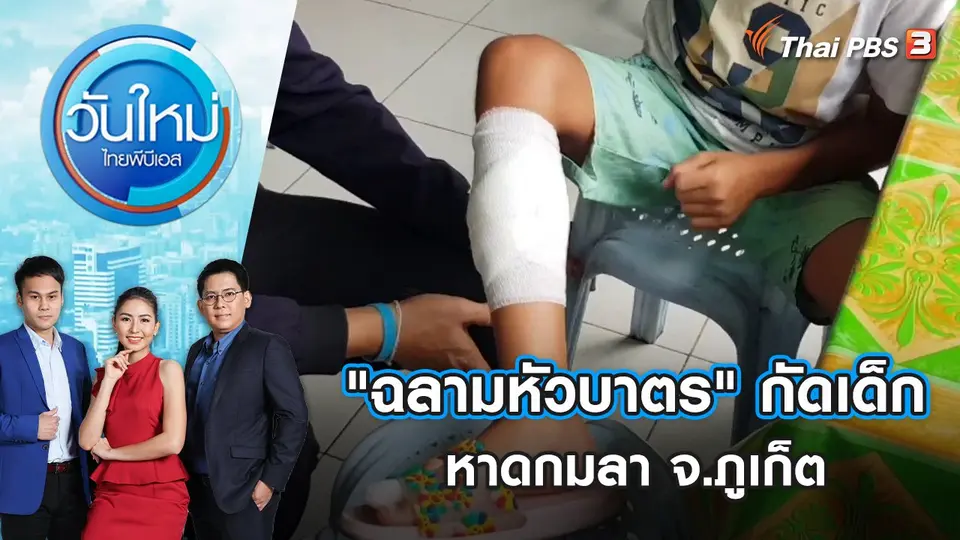 ชี้รอยแผล "ฉลามหัวบาตร" กัดเด็กที่หาดกมลา จ.ภูเก็ต | วันใหม่ ไทยพีบีเอส | 3 พ.ค. 65